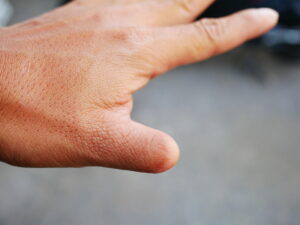 closeup of hand with amputated thumb.
